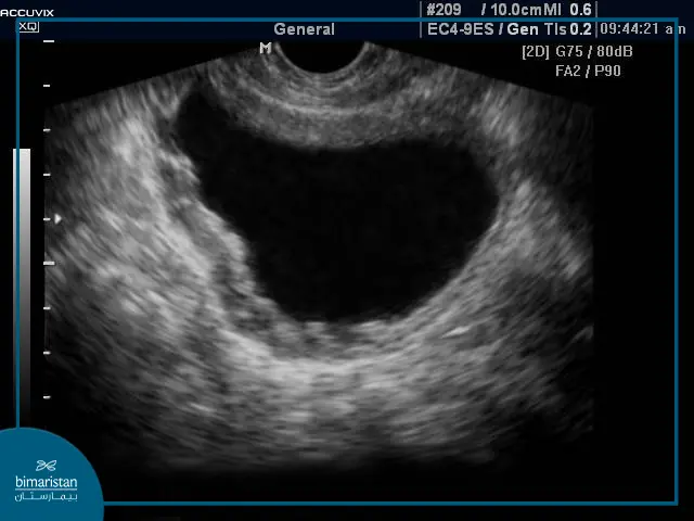 Diagnosis Of Chronic Cystitis In Women By Ultrasound