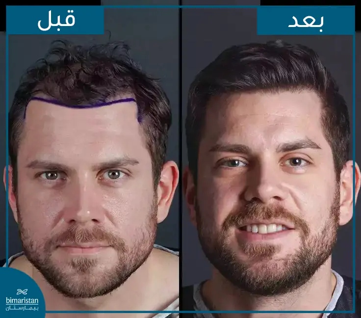 قبل وبعد زراعة الشعر