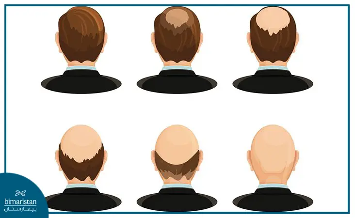 Stages Of Hereditary Baldness In Men