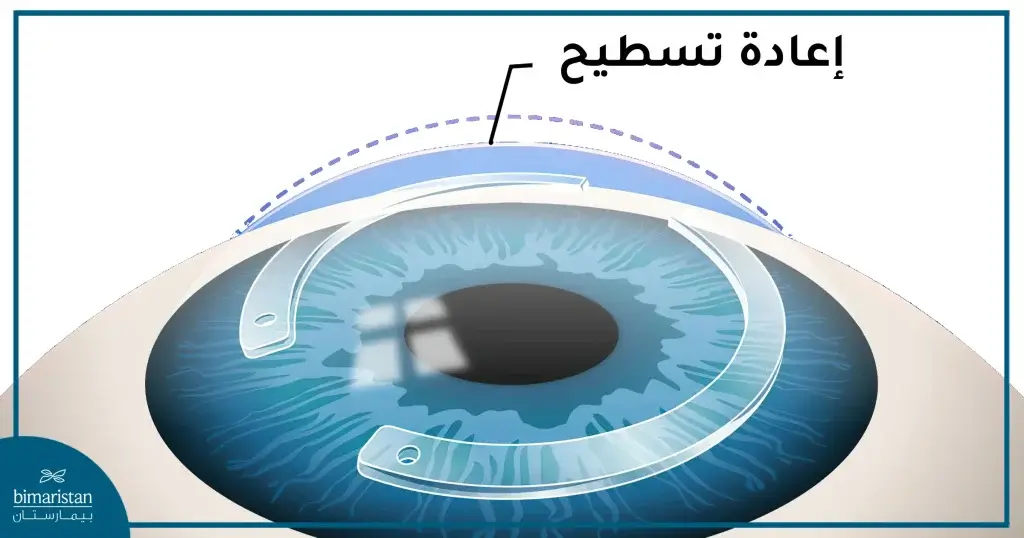 نلاحظ القطع البلاستيكية على شكل هلال لإعادة تشكيل سطح القرنية.