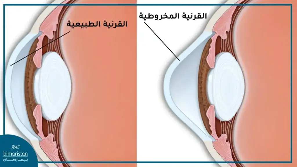 نلاحظ تغير شكل القرنية المخروطية من الإنحناء إلى التقبب.