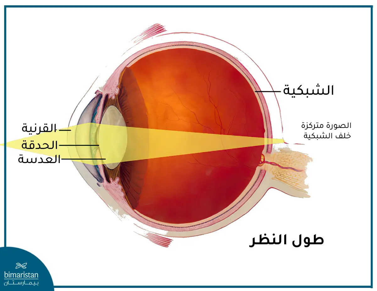 توضع الصورة خلف الشبكية في طول النظر