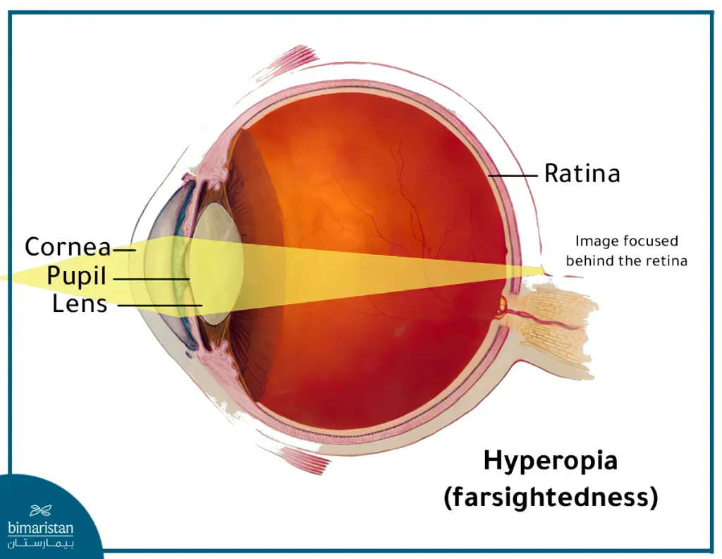 Image Focused Behind The Retina In Farsightedness