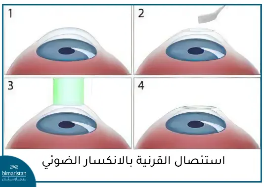 مراحل عملية استئصال القرنية بالانكسار الضوئي