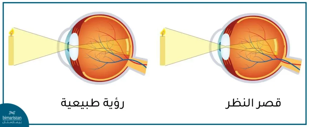 نلاحظ توضع الخيال أمام الشبكية في قصور النظر