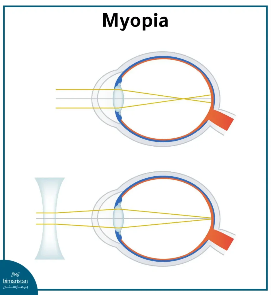 Concave Lenses Are Used To Treat Nearsighted People