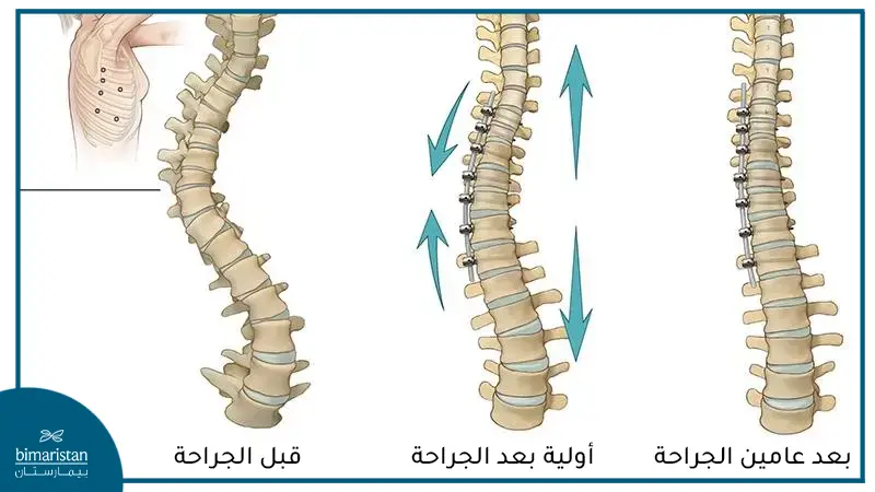 ربط الجسم الفقري لعلاج الجنف في قسم جراحة الأطفال في تركيا