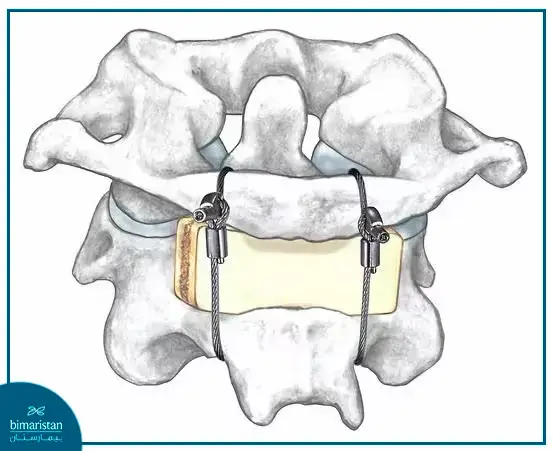 Fusion Of The First And Second Cervical Vertebrae Using The Brooks Technique