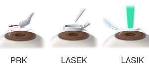 Types Of Laser Eye Surgery