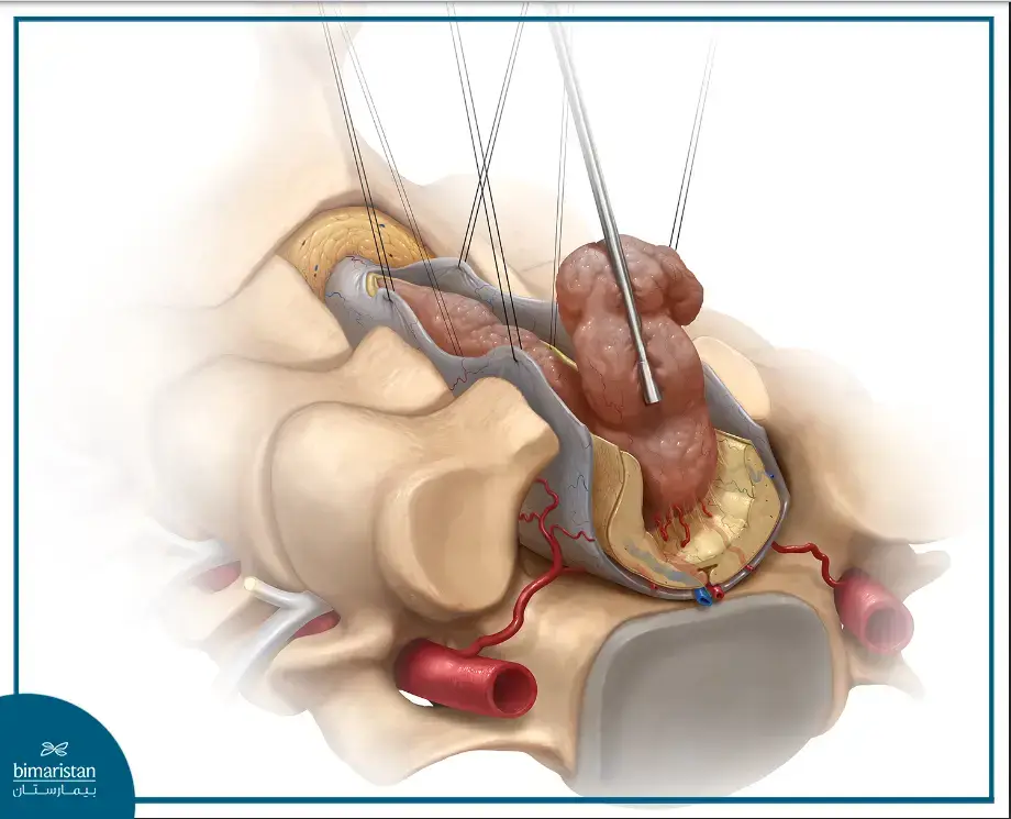 جراحة استئصال ورم في النخاع الشوكي في مراكز جراحة الأعصاب والمخ في تركيا