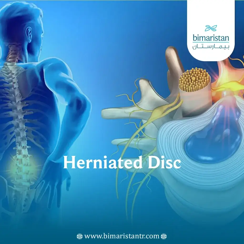 Herniated Disc