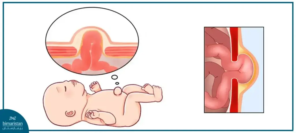 Umbilical Hernia In Children