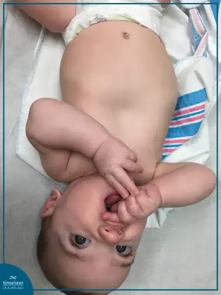 Pectus Excavatum In Children