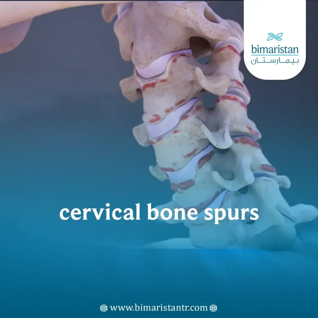 Cervical Bone Spurs