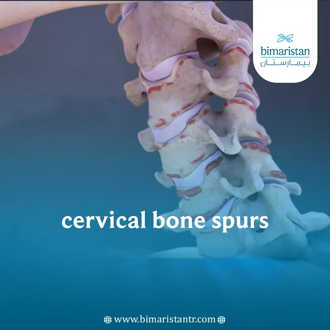 Cervical Bone Spurs