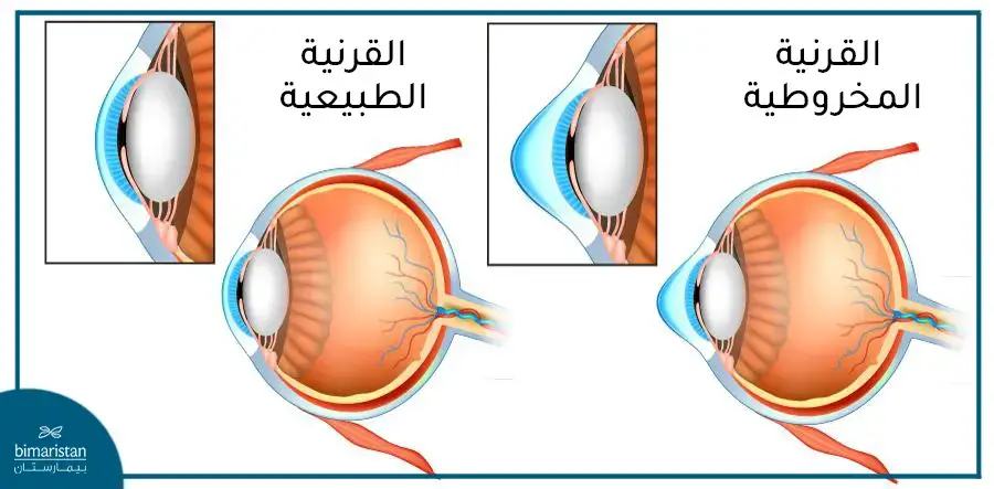 القرنية الطبيعية والقرنية المخروطية