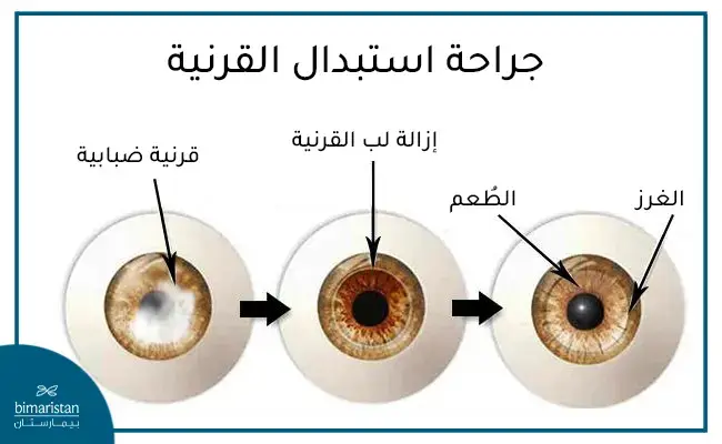 جراحة استبدال القرنية 