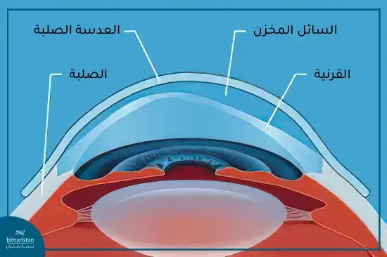 العدسات الصلبة لعلاج القرنية المخروطية 