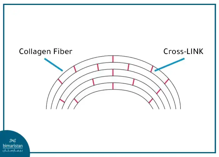 Principle Of Corneal Cross-Linking Operation