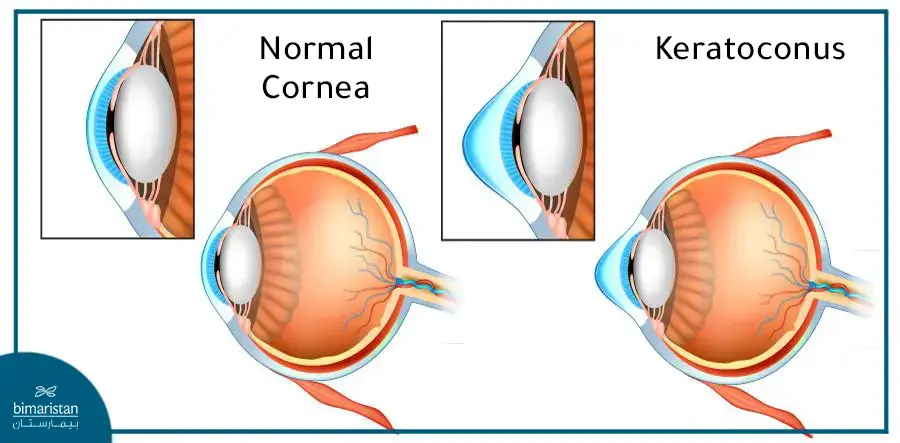 The Difference Between The Normal Cornea And Keratoconus