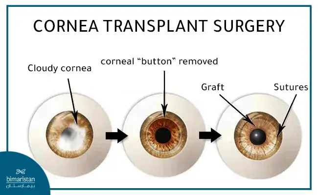 Cornea Transplant Surgery