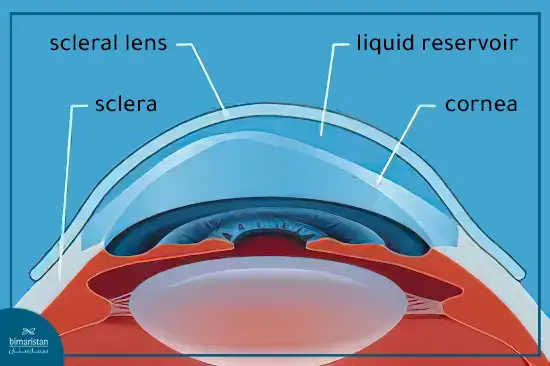 Scleral Lenses For Treatment Of Keratoconus Scleral Lenses For Treatment Of Keratoconus