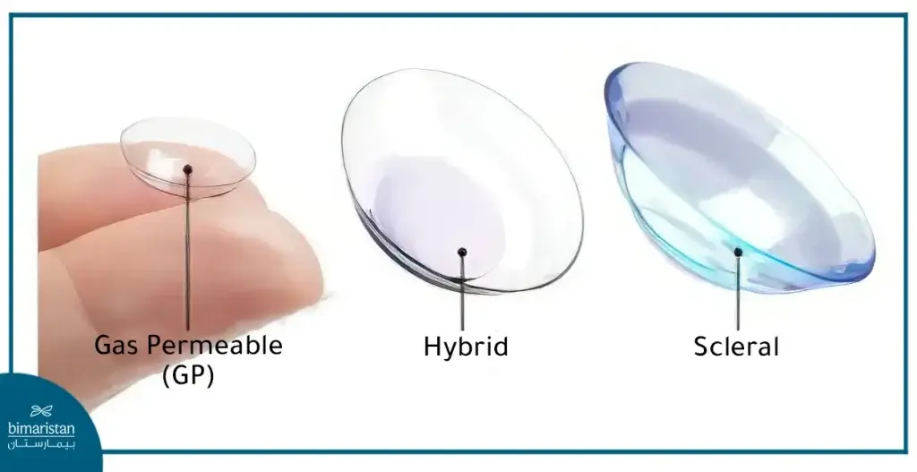 Contact Lenses For Keratoconus