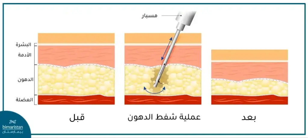 عملية شفط الدهون التقليدية