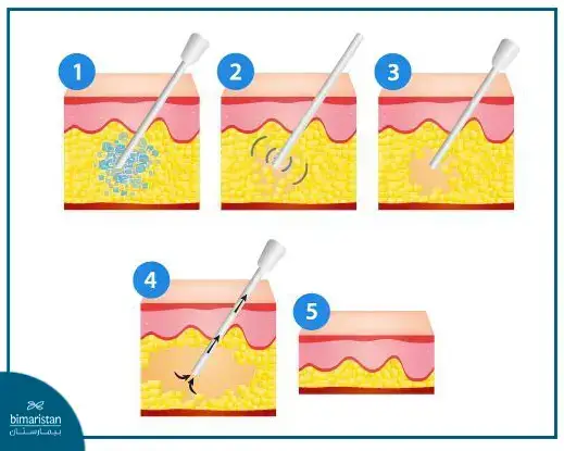 Stages Of The Vaser Liposuction Process