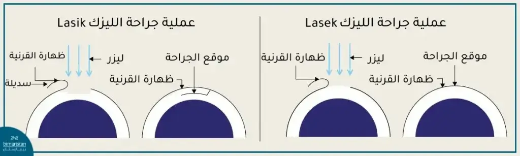 قصر النظر 5