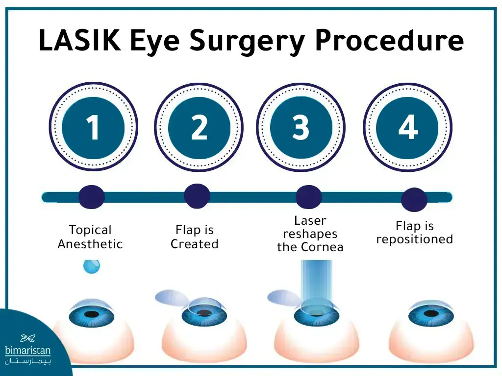 Lasik Surgery Procedure