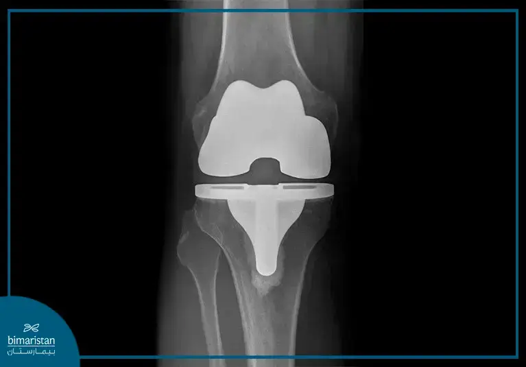 Radiograph Of The Artificial Knee Joint