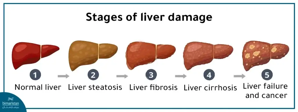 An Image Showing The Stages Of Liver Damage That Requires Treatment For Cirrhosis