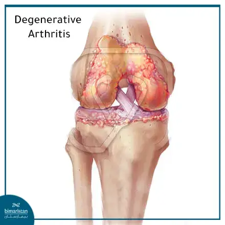 Degenerative Knee Osteoarthritis (Knee Osteoarthritis)