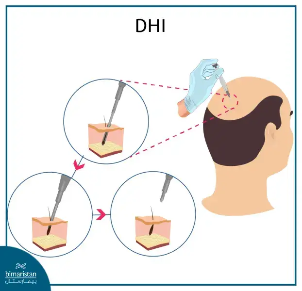 Dhi (Direct Hair Implantation) With Choi Pen