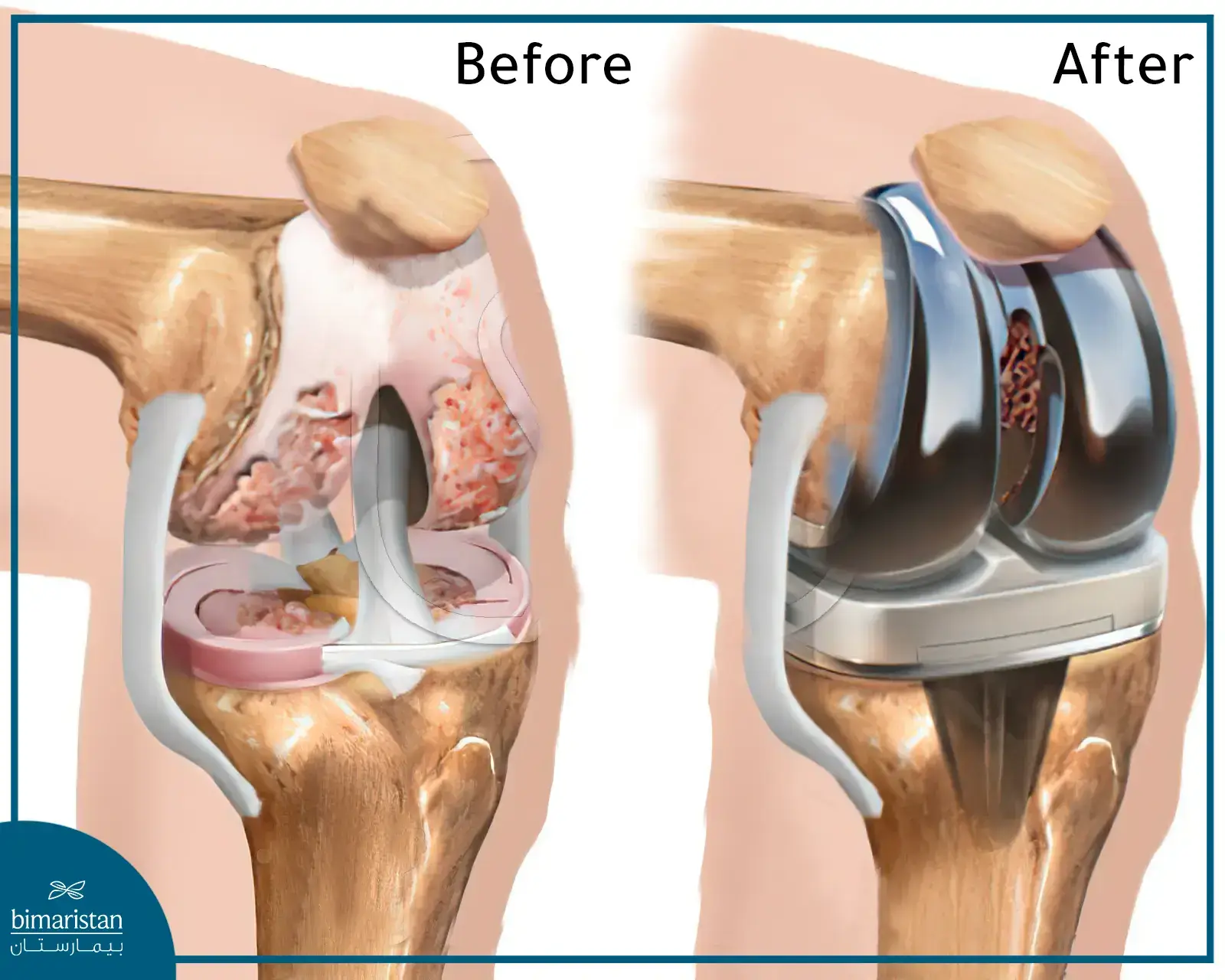 Before And After Total Knee Replacement Surgery