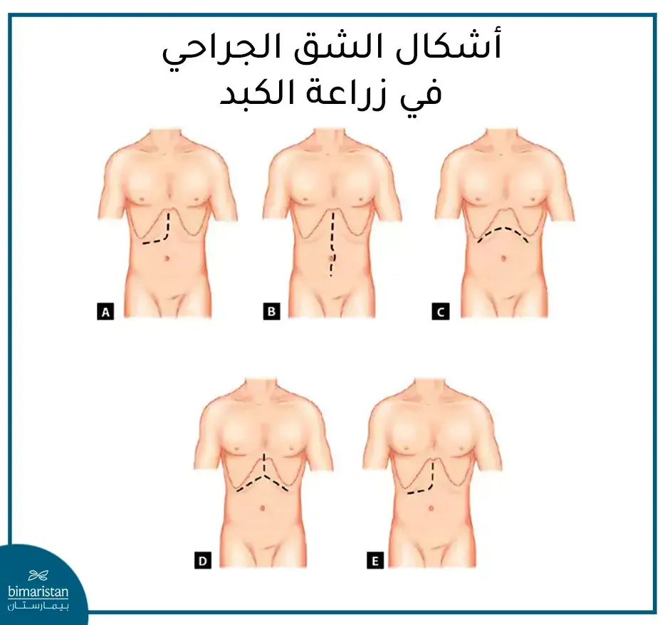 أشكال ومواقع الشقوق الجراحية التي يتم إجراؤها أثناء زراعة الكبد