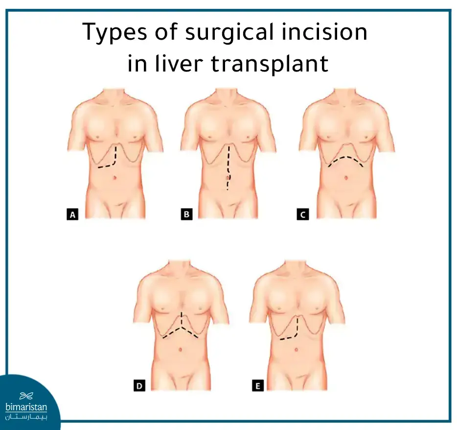 Forms And Locations Of Surgical Incisions Made During Liver Transplantation