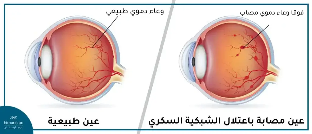 اعتلال الشبكية السكري