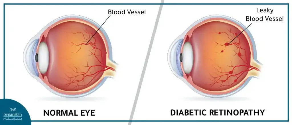 Diabetic Retinopathy