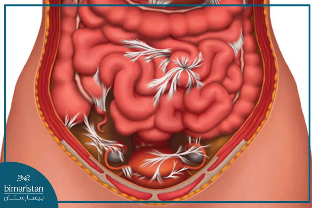 Abdominal Adhesions Shape