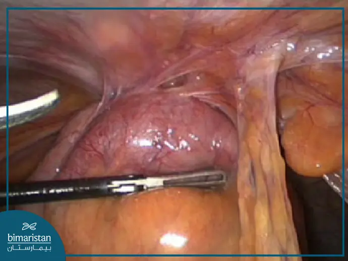 Intestinal Adhesion Release Surgery