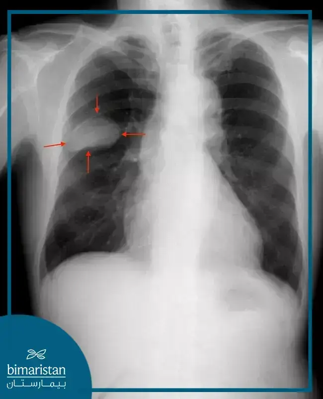 Diagnosis Of Malignant Lung Tumor