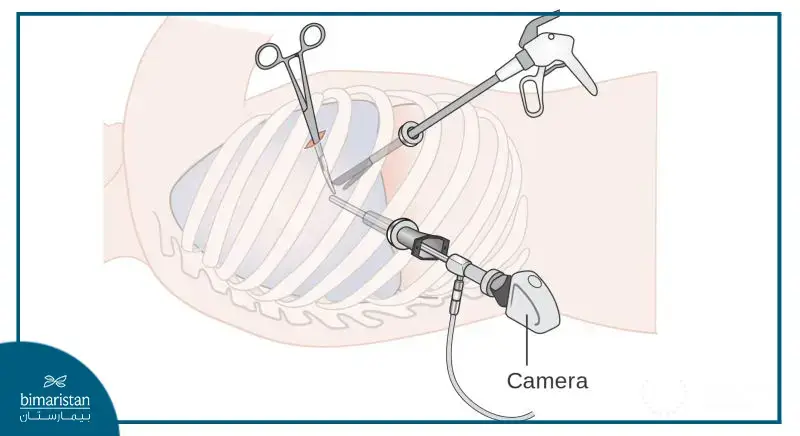 Vats Lobectomy