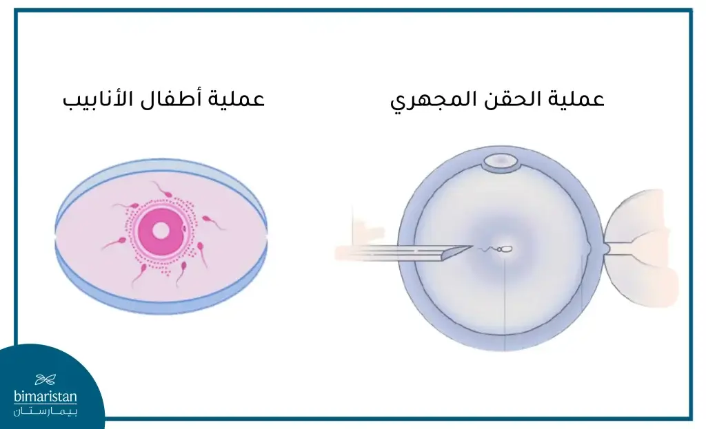 الفرق بين عملية الحقن المجهري وعملية أطفال الأنابيب