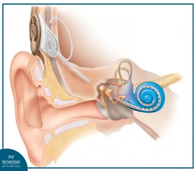 Cochlear Implant Surgery