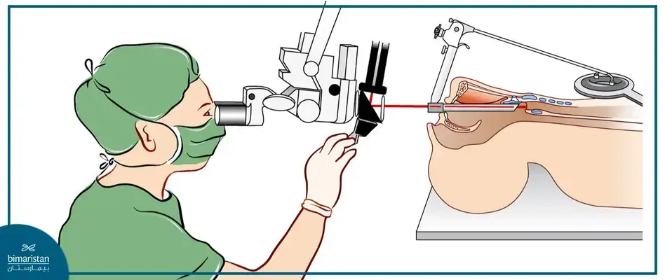 Microlaryngoscopy