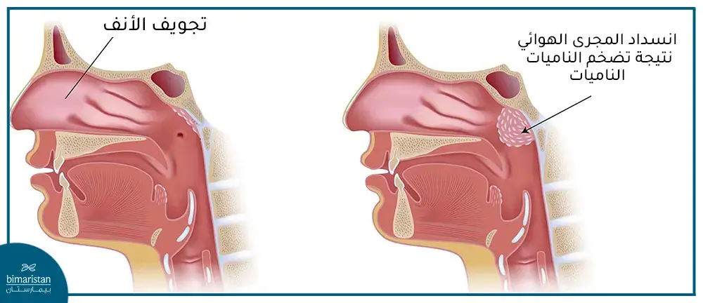 عملية استئصال الناميات في قسم جراحة الأذن والأنف والحنجرة