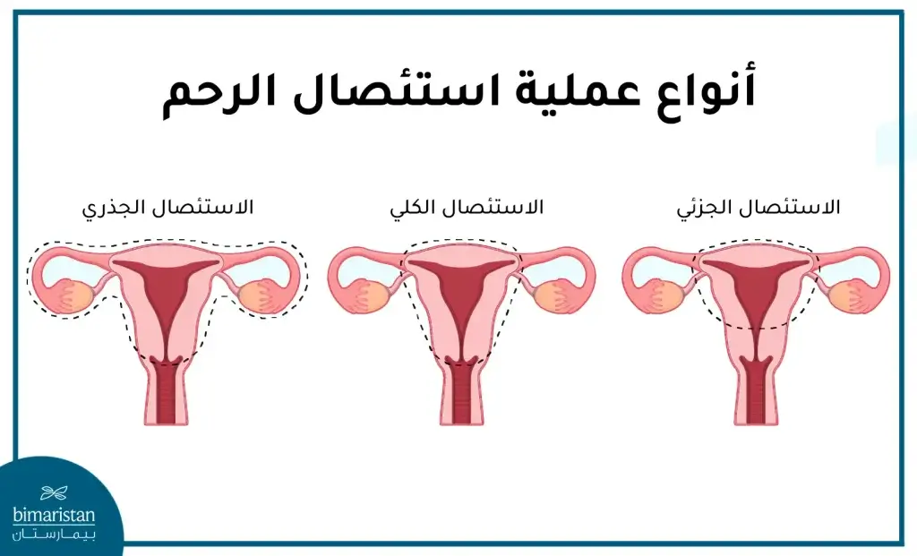 أنواع جراحات استئصال الرحم