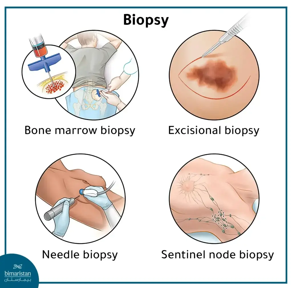 Types Of Cancer Biopsy